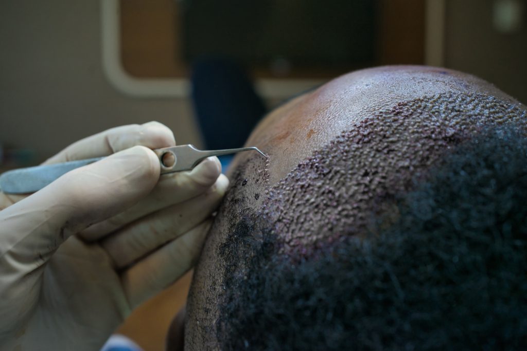 how much is a hair transplant in turkey